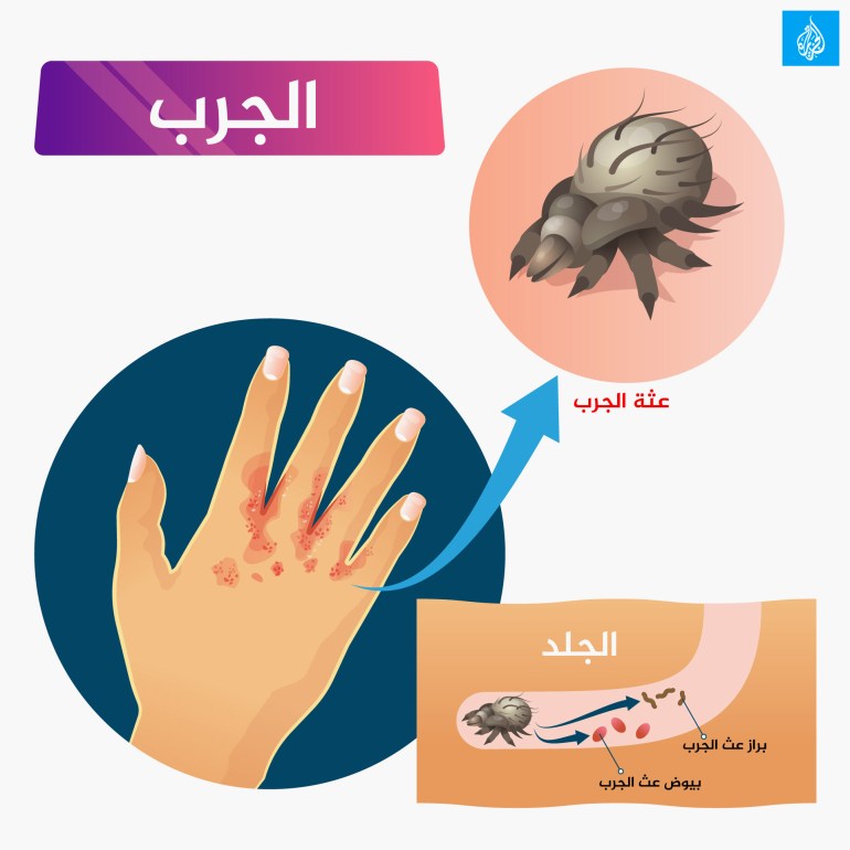 السكابيوس سكابيوس الجرب جرب scabies 